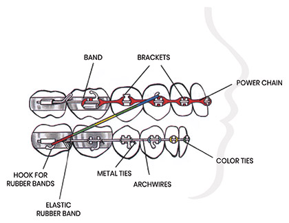 What Rubber Band Colors Say About You! - Braces in CA