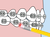 Loose Appliance, Bracket or Wire - Charles C. Low Orthodontics